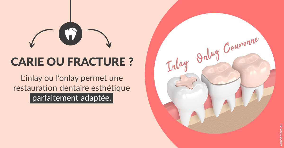 https://dr-coat-philippe.chirurgiens-dentistes.fr/T2 2023 - Carie ou fracture 2