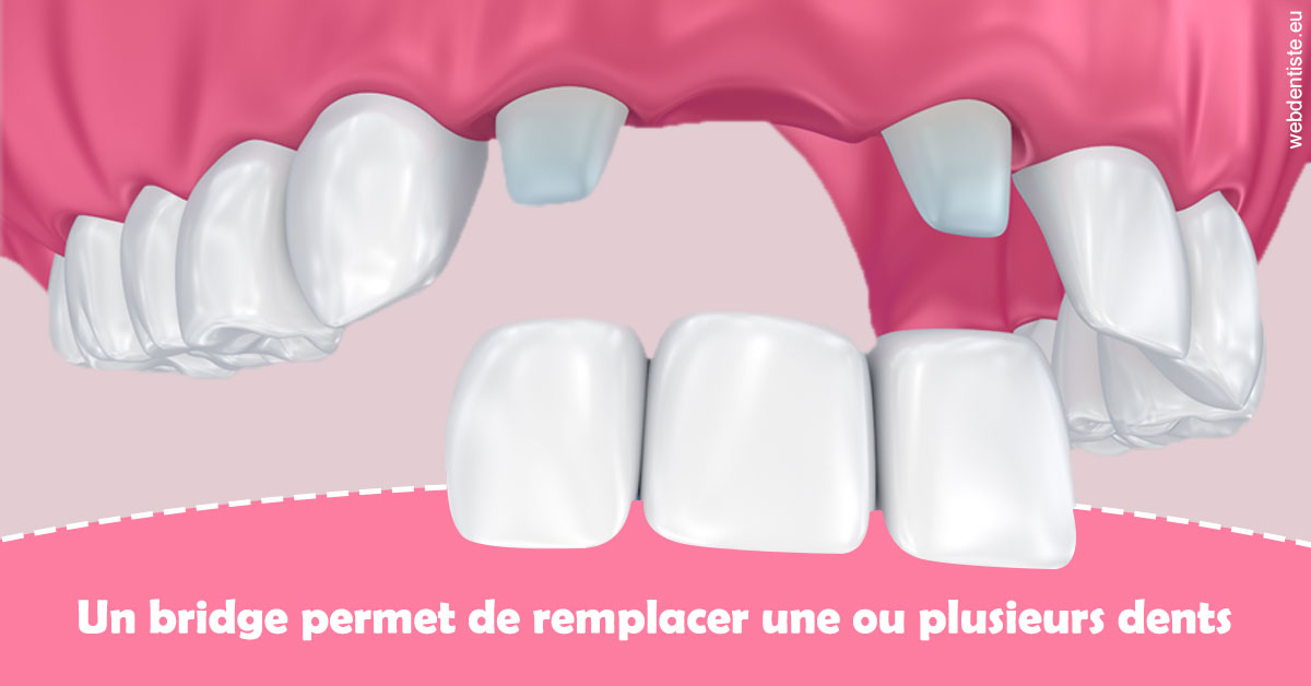 https://dr-coat-philippe.chirurgiens-dentistes.fr/Bridge remplacer dents 2