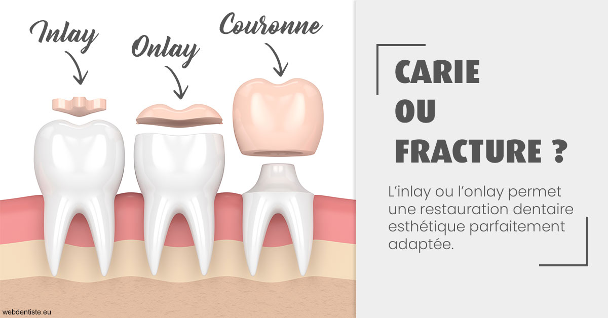 https://dr-coat-philippe.chirurgiens-dentistes.fr/T2 2023 - Carie ou fracture 1