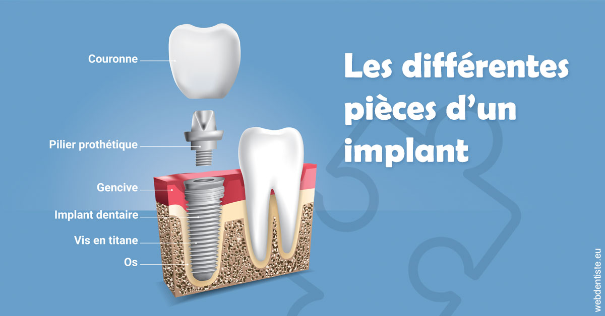 https://dr-coat-philippe.chirurgiens-dentistes.fr/Les différentes pièces d’un implant 1